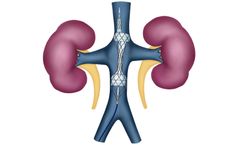 Magenta - Model TRVD - Transcatheter Renal Venous Decongestion System