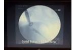Cure Ex Nail Fungus Laser Device - Video