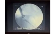 Cure Ex Nail Fungus Laser Device - Video