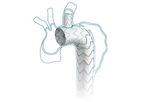 Castor Tevar - Branched Thoracic Stent-Graft System