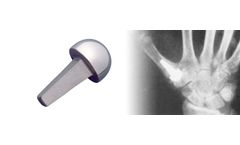 Swanson - Titanium Basal Thumb Implants