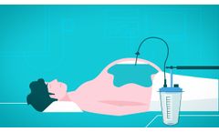 Alfapump - New Ascites Treatment for More Quality of Life - Video
