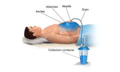 Liver Disease (Nash) and Ascites