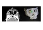 Axial3d - Solution for Craniomaxillofacial Surgery