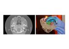 Axial3d - Transforming Treatment Solution for Craniomaxillofacial Neurosurgery