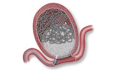 Aneura - Embolization Device