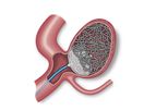 Endura - Embolization Device