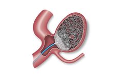 Endura - Embolization Device