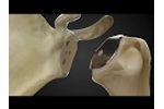Catalyst Stemless Total Shoulder Replacement Animation - Video