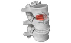 Parametrics - Model Demineralized Bone Matrix (DBM) - Bone Grafts