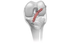 Coll-e-Strong - Allograft Tendons