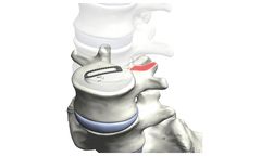 Tyber - Posterior/Oblique Lumbar Interbody Fusion (PLIF/OLIF)