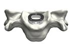 Tyber - Anterior Cervical Interbody Fusion (ACIF)