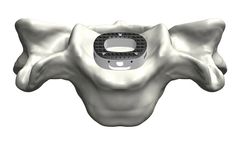 Tyber - Anterior Cervical Interbody Fusion (ACIF)