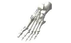 Tyber - Model NiTy - Intraoperative Memory Staple
