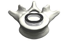 Tyber - Anterior Lumbar Interbody Fusion (ALIF)