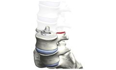 Tyber - Transforaminal Lumbar Interbody Fusion (TLIF)