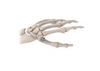 BioPro - Modular Thumb Implant