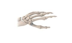 BioPro - Modular Thumb Implant