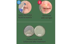 Ondine Steriwave - Nasal Photodisinfection Therapy Technology For Healthcare