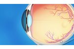 What is Glaucoma? - Video