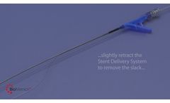 Stent Deployment - Video