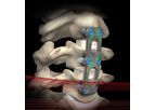 Nakoma - Model SL - Anterior Cervical Plate System