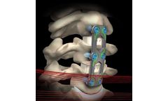 Nakoma - Model SL - Anterior Cervical Plate System