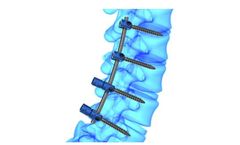 FusePSS - Open Pedicle Screw System
