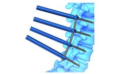 FusePSS - Model MIS - Pedicle Screw System