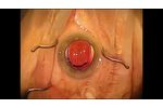Daniel Gradin, MD, Showcases RayOne???s Superb Centration - Video