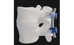 PressON - Single Level Spinal Implant