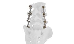 PressON - Multi-Level Spinal Implant