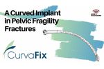 CurvaFix - A Curved Implant in Pelvic Fragility Fractures - Video