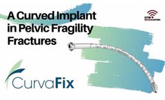 CurvaFix - A Curved Implant in Pelvic Fragility Fractures - Video