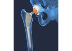 Tecomet - Femoral Heads