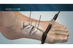 DynaBunion 4D Minimal-Incision Lapidus System - Featuring Gen 2 Instruments - Video