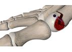 MINIBunion - Minimally Invasive Implant