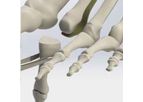 Crossroads - Model STRoPP - Single Tunnel Repair Plantar Plate System