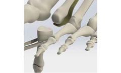 Crossroads - Model STRoPP - Single Tunnel Repair Plantar Plate System