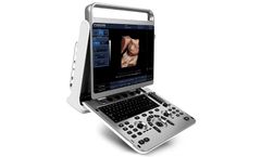 CHISON - Model EBit 30 - Portable Ultrasound Machine