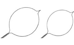 Polypectomy