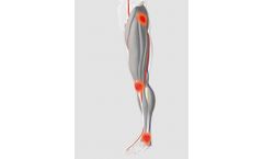 Neuromuscular Electrostimulation Device for Post-Operative Oedema Prevention - Hospital Applications