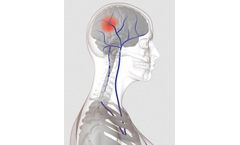Neuromuscular Electrostimulation Device for VTE Prevention - Acute Stroke- Hospital Applications