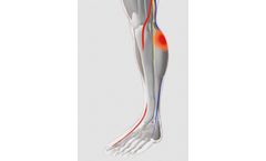 Neuromuscular Electrostimulation Device for VTE Prevention – NICE Guidance- Hospital Applications