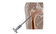 EBERLE - Model HIP - Piloted Bone Trephine (PBT)