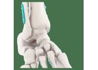 Expert Knotless Dual - Double Joint Flexible Fixation