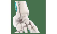 Expert Knotless Dual - Double Joint Flexible Fixation