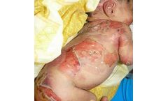 InMed - Model INM-755 - Cannabinol Topical Cream for the Treatment of Epidermolysis Bullosa