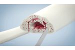 Bonalive granules in septic non-union treatment - Video